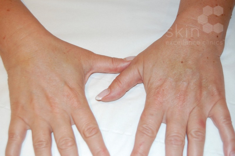 Before hand rejuvenation  Photo